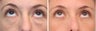 Before & After Blepharoplasty Patient 19