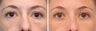 Before & After Blepharoplasty Patient 19