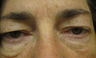 55 year old woman treated for droopy eyelid and eyelid bags
