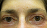 55 year old woman treated for droopy eyelid and eyelid bags