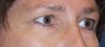 Heavy brows and puffy lower lids in this younger female