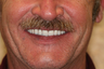 50 year old male treated with All-on-4 Dental Implant Procedure