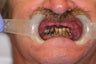 50 year old male treated with All-on-4 Dental Implant Procedure