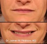 Injectable Filler Treatment