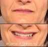 Injectable Filler Treatment