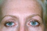 BOTOX