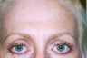 BOTOX