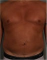 44 year old male with belly fat that despite dieting and exercise