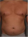 44 year old male with belly fat that despite dieting and exercise