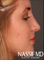 Female Primary Rhinoplasty