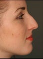 Female Primary Rhinoplasty