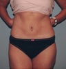 Tummy Tuck