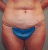 Tummy Tuck