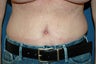 tummy tuck revision