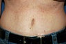 tummy tuck revision