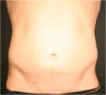 SmartLipo MPX
