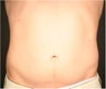 SmartLipo MPX