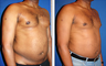 Liposuction Before & After