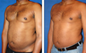 Liposuction Before & After