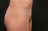 40 year old coolsculpting