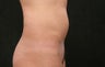 40 year old coolsculpting