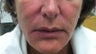 50 Year Old Female treated with Sculptra