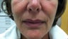 50 Year Old Female treated with Sculptra