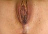 Vaginal Rejuvenation & Labiaplasty