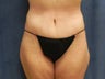 Body Lift