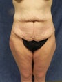 Body Lift