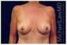 Breast Lift