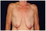 Breast Lift