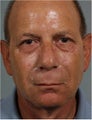 62 year old male treated with Sculpra injections for lost facial volume and skin sagging