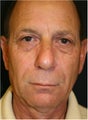 62 year old male treated with Sculpra injections for lost facial volume and skin sagging