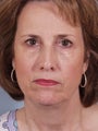 Upper and Lower Eyes along with a brow lift