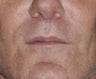 50 Year old Male Treated For A Thin Upper Lip