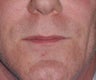 50 Year old Male Treated For A Thin Upper Lip