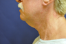 Law Liposuction and Ultherapy