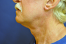 Law Liposuction and Ultherapy