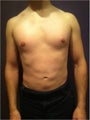 Laser Liposuction
