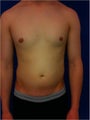 Laser Liposuction