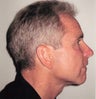 Neck lift in 49 year old man
