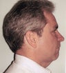 Neck lift in 49 year old man