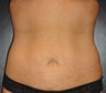 SmartLipo MPX