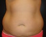 SmartLipo MPX