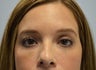 32 Year Old Female Treated for Under Eye Hollows