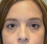 32 Year Old Female Treated for Under Eye Hollows
