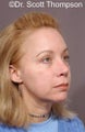 Revision Rhinoplasty Surgery