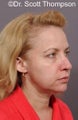 Revision Rhinoplasty Surgery