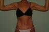 brachioplasty